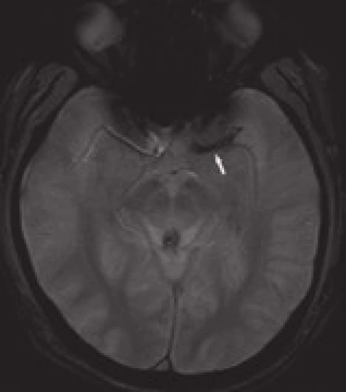 „Blooming artifact“ – zobrazení trombu na MRI-GRE – obdoba dens artery sign na CT.