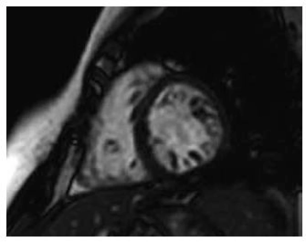 Obraz nekompaktní kardiomyopatie magnetickou rezonancí, end-diastola – poměr mezi nekompaktní a kompaktní vrstvou je &gt; 2,3.