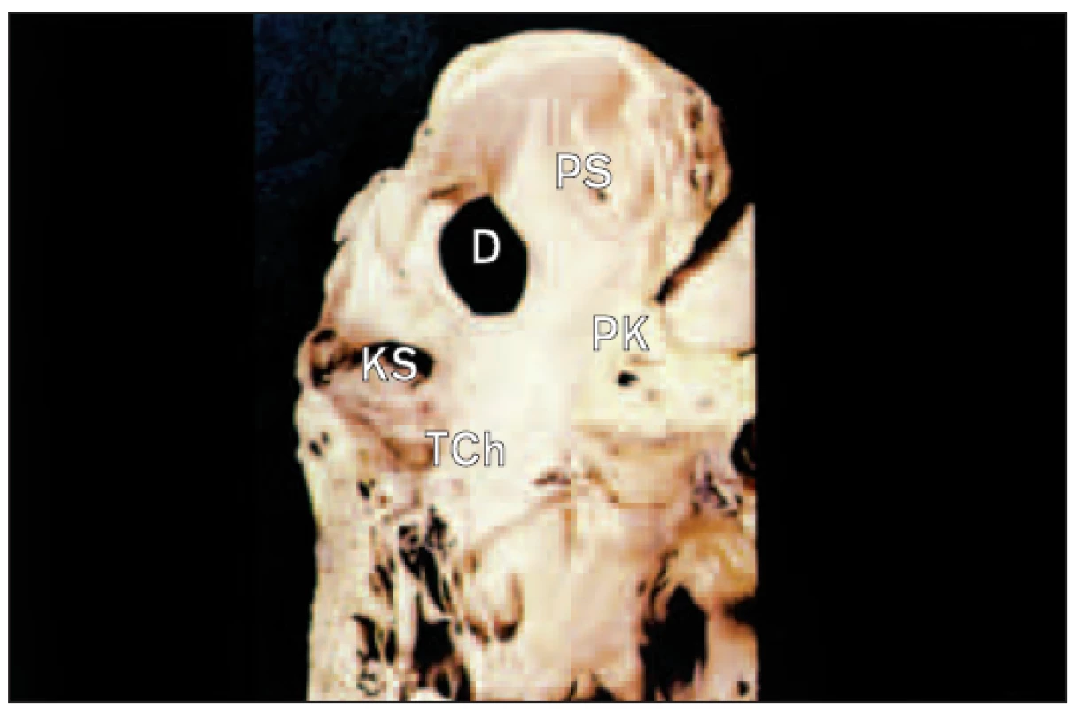 Defekt septa síní druhého typu. Jednoduchý okrouhlý defekt zaujímá místo foramen ovale. Koronární sinus leží dole a trikuspidální chlopeň je oddělena od defektu několika centimetry svalové tkáně.