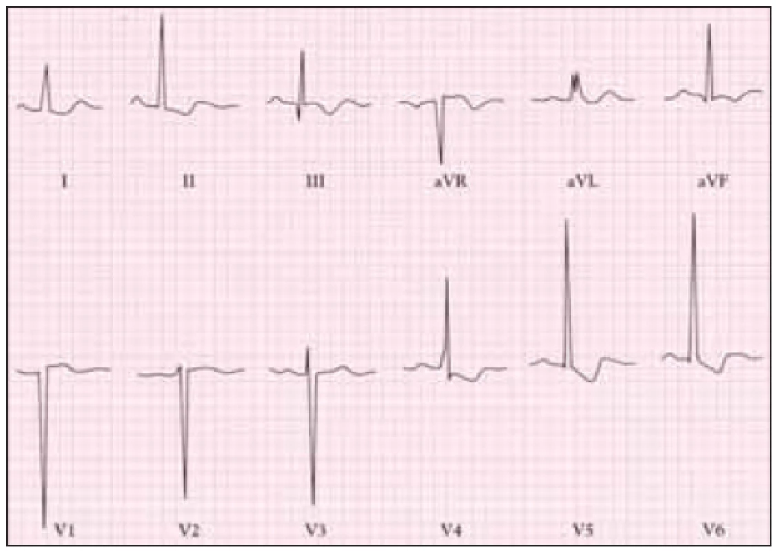 EKG u těžké stenózy aorty ukazuje hluboký kmit S ve V1 a vysoké kmity R ve V5 se změnami ST-T poukazující na hypertrofii levé komory.