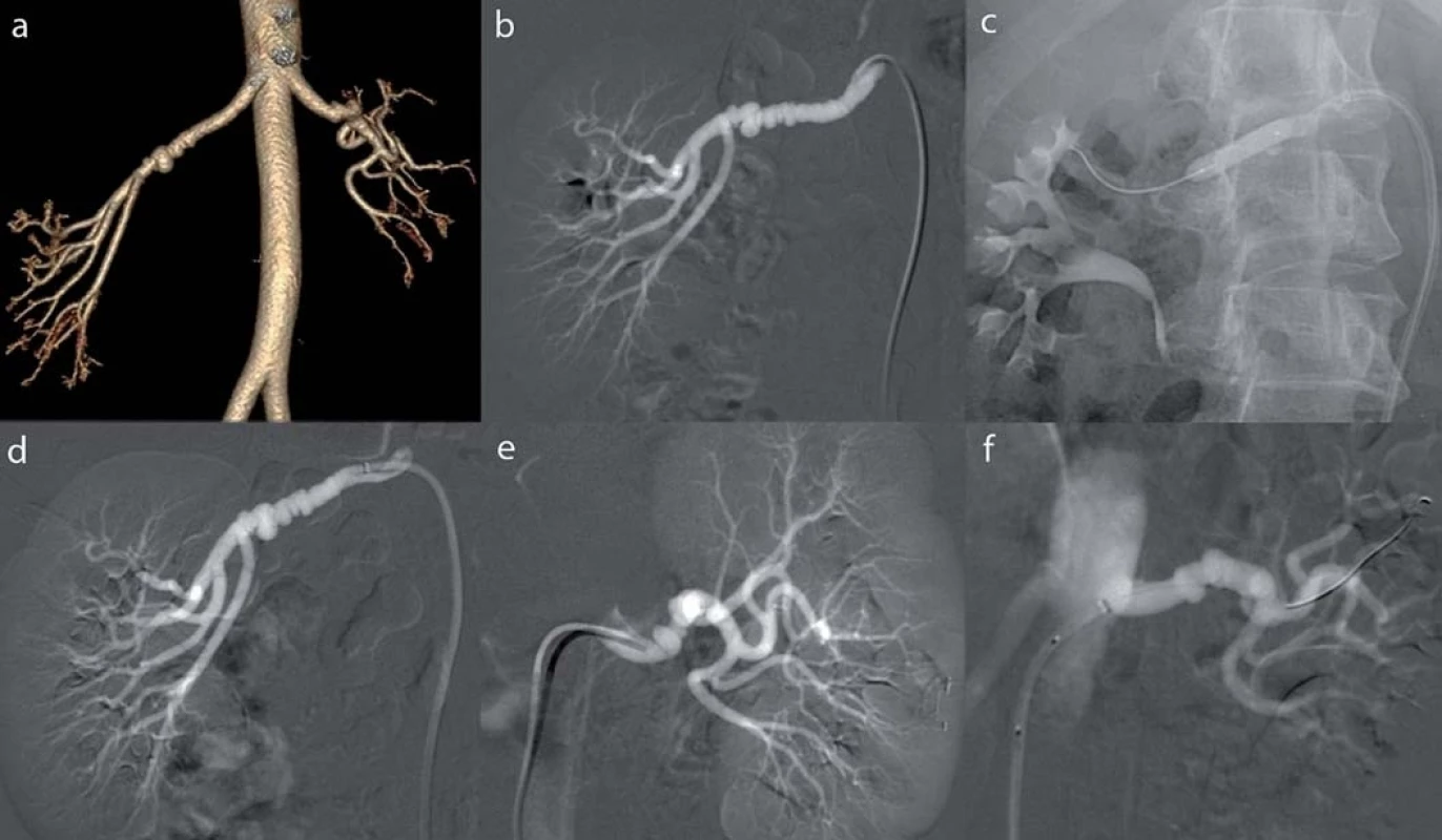 Multifokální fibromuskulární dysplazie u 36leté ženy: a) CT-angiografie renálních tepen ve 3D rekonstrukci. Bilaterálně nález aneuryzmatického rozšíření a krátké stenózy, b) selektivní angiografi e pravé renální tepny, c) PTA, rozvinutý balonkový dilatační katetr, d) kontrolní angiografie s příznivým nálezem, e) selektivní angiografi e levé renální tepny, f) kontrolní angiografie po dilataci. Převzato z [10].