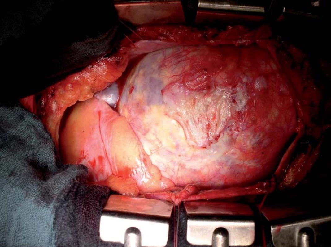 Marfanův syndrom, operační nález: těžká dilatace aorty 
