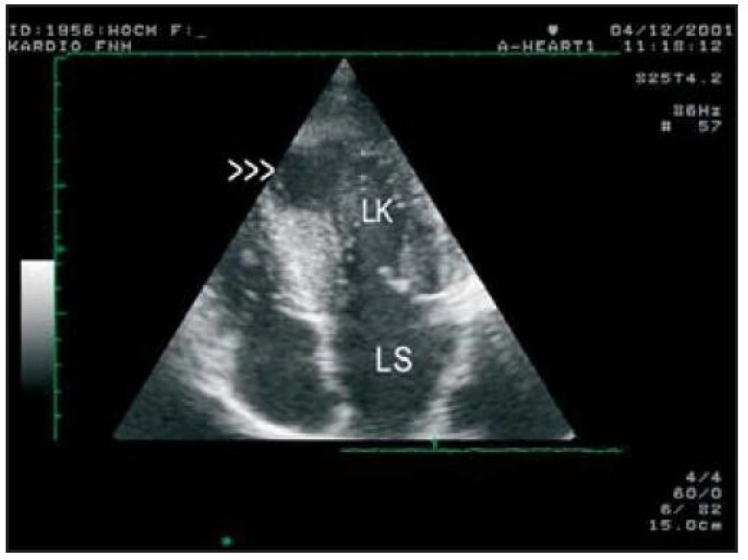 Transtorakální echokardiografie, 4dutinová projekce. Je přítomno menší aneuryzma (šipky) v hrotu LK.