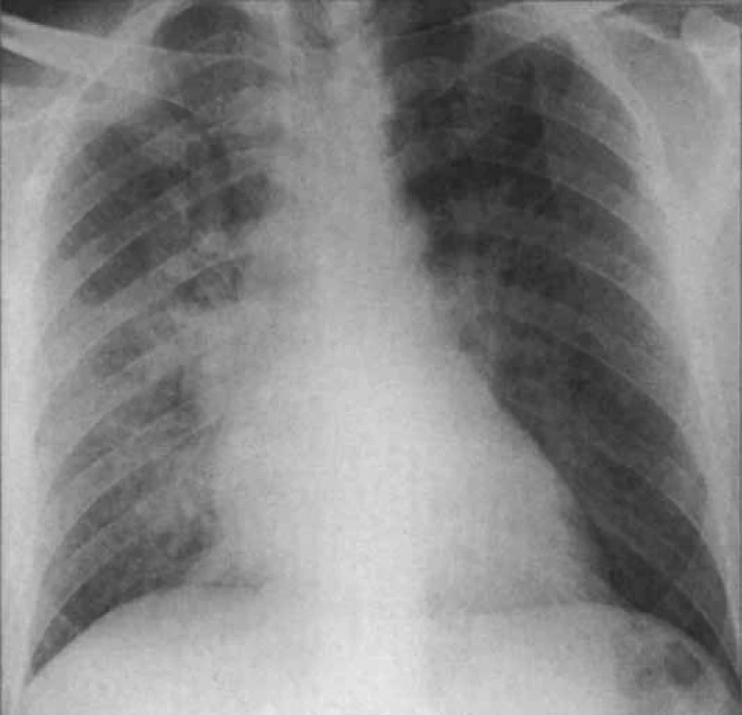 RTG ukazuje plicní edém a normální srdeční siluetu při akutní aortální regurgitaci způsobené rupturou cípu.
