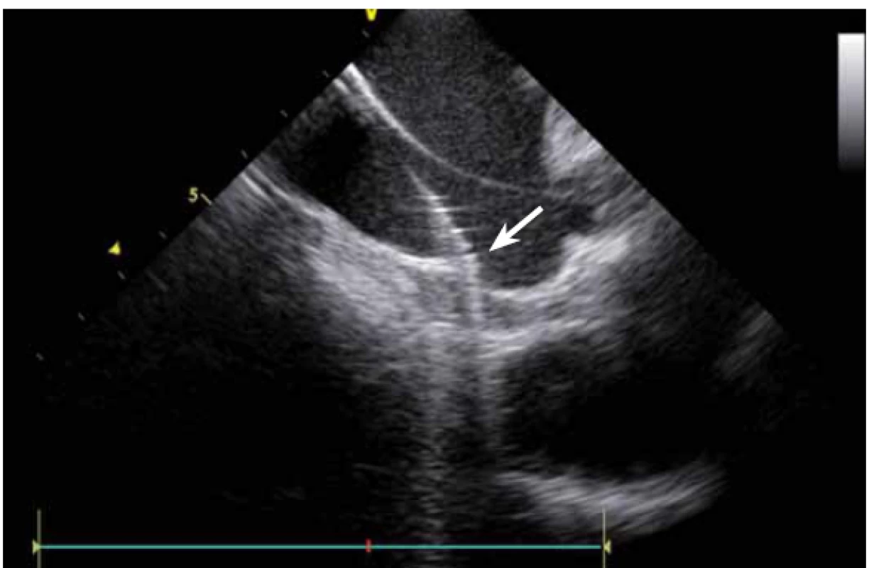 Poloha katetru při ablaci. Hrot ablačního katetru na dolním okraji antra levé dolní plicní žíly. Druhý, diagnostický, katetr zavedený do ústí levé horní plicní žíly.
