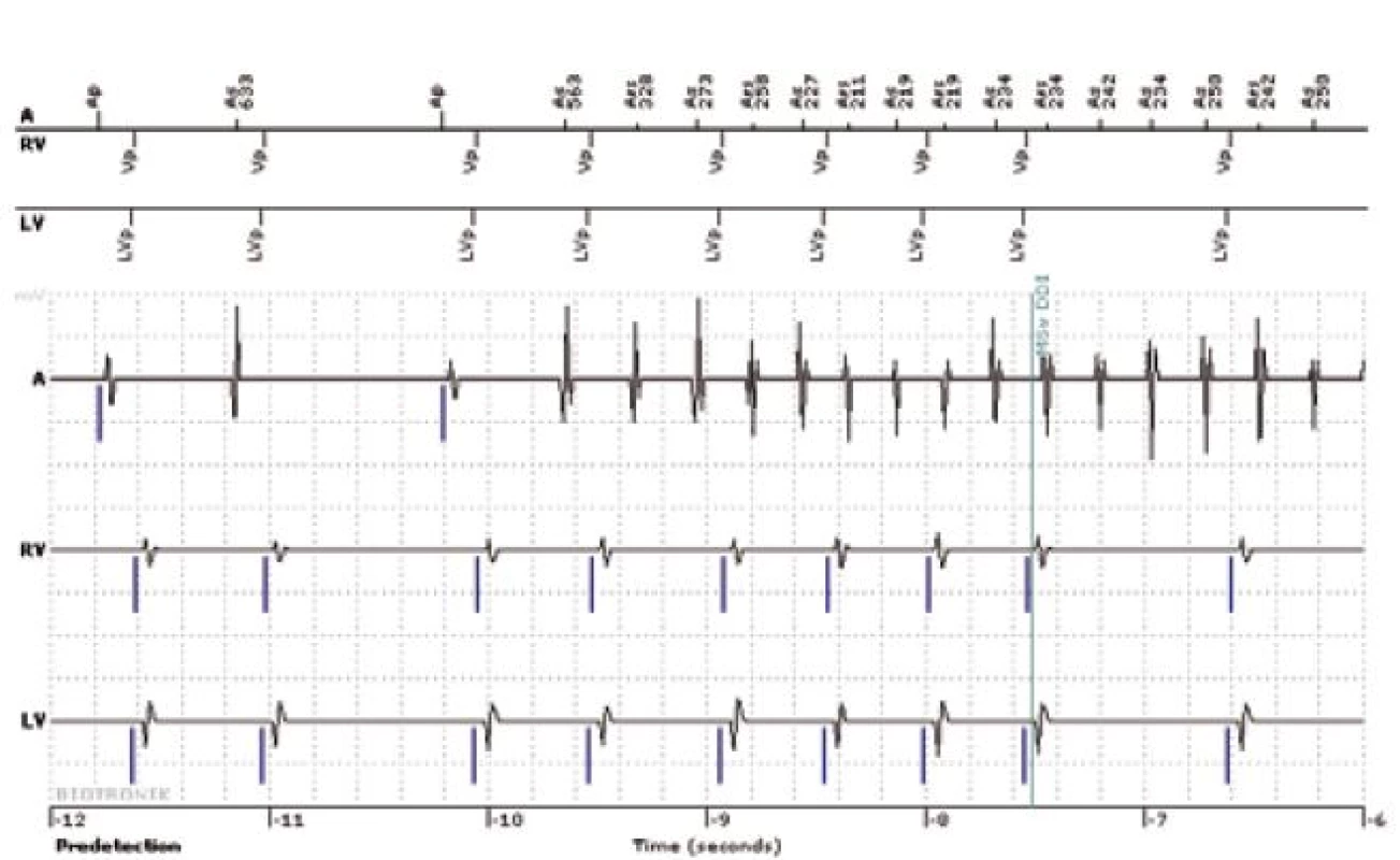 Intrakardiální elektrogram s nástupem supraventrikulární arytmie u pacienta s biventrikulárním ICD sledovaného systémem Biotronik Home Monitoring. 
Nahoře: markerový kanál (Ap = stimulace síní, As = síňové vnímání, Ars = síňové vnímání v refrakterní periodě, Vp = pravokomorová stimulace, LVp = levokomorová stimulace), dole IEGM, A = síňový kanál, RV = pravokomorový kanál, LV levokomorový kanál. Po třetím stahu se rozbíhá rychlá síňová aktivita, která je nepravidelně převáděna na komory (síňové vnímání v době refrakterity se uplatňuje v hodnocení síňové frekvence, ale nespouští komorovou stimulaci). Po ověření běžící supraventrikulární arytmie dojde k přepnutí do režimu DDI (MSw DDI), tzv. mode switch, přepnutí do režimu bez možnosti spouštění komorové stimulace síňovým vnímáním.