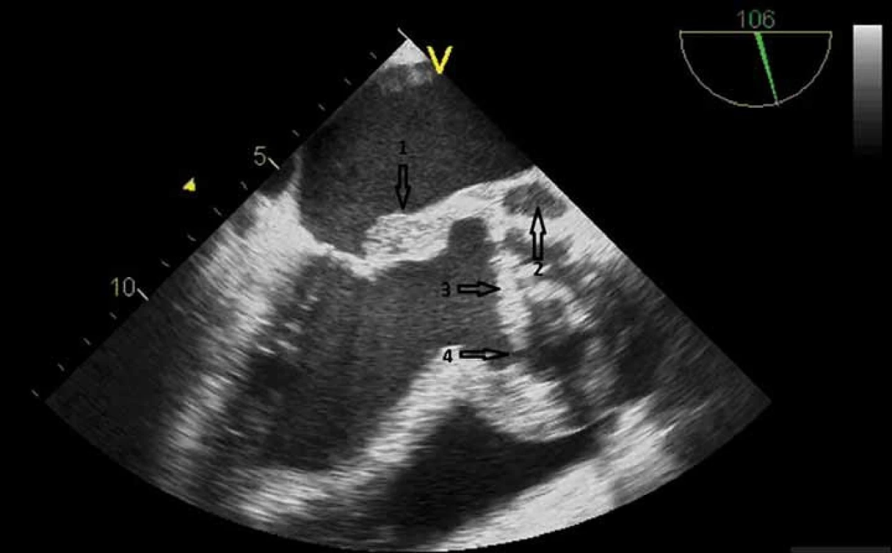 Jícnové echokardiografické vyšetření. Infekční endokarditida chlopenní náhrady v aortální pozici s destrukcí kořene a sekundárním postižením mitrální chlopně. Je patrná vegetace (šipka 1), paravalvární absces (šipka 2), uvolněná aortální protéza s paravalvárním leakem (šipky 3 a 4).