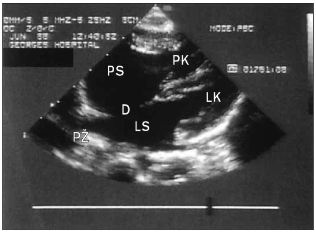 Subkostální 2D-pohled u dítěte s defektem septa síní typu ostium secundum. Je trvalý výpadek echosignálu ve střední oblasti síňového septa (defekt v místě fossa ovalis). Pravé srdeční oddíly
jsou zvětšené a plicní žíly prominují.