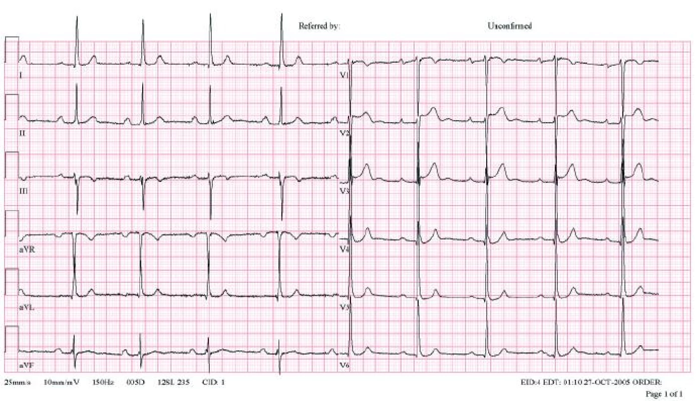 Elektrokardiogram 48letého muže, aktivního sportovce – cyklisty. V EKG patrna sinusová bradykardie, AV-blok I. stupně s intervalem PQ 0,25, voltážová kriteria hypertrofie levé komory srdeční, nespecifické repolarizační změny.