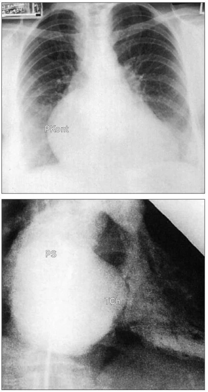 RTG trikuspidální stenózy. a) Frontální snímek ukazuje zvětšení kontury pravého srdce a jeho vyklenutí doprava. b) Doprovodný angiogram pravé síně v mírně pravé přední šikmé projekci ukazuje velkou pravou síň s ouškem a také ztluštělou stenotickou trikuspidální chlopeň.