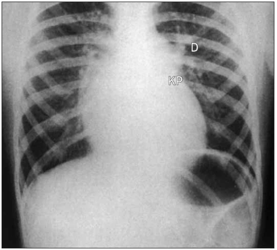 Skiagram defektu septa síní typ ostium primum s mitrální regurgitací: mírně rozšířený srdeční stín, prominující kmen plicnice – dilatace cév v horní zóně