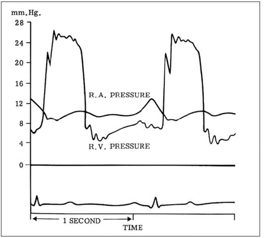 Tlakové záznamy u pacienta s trikuspidální stenózou ukazují diastolický gradient mezi pravou síní a pravou komorou.