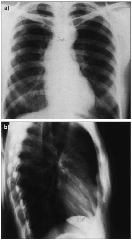 Kongenitální stenóza aortální chlopně u mladého člověka. Frontální snímek (a) ukazuje normální tvar srdce s prominující vzestupnou aortou a aortálním obloukem, který je u 20leté ženy abnormální. Boční pohled (b) ukazuje vyklenutí levé komory dozadu k pravé síni, ohraničené dolní dutou žilou.