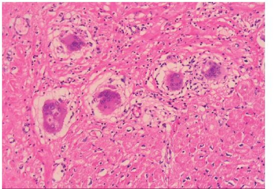 Histologie sarkoidózy myokardu (barvení HE, původní zvětšení 200×). Chudý lymfoidní infiltrát intersticia doprovázený jizvením a výraznou obrovskobuněčnou reakcí s tvorbou epiteloidních granulomů bez nekrózy kardiomyocytů. Některé obrovské buňky (vlevo) mají v cytoplazmě asteroidní inkluze, tzv. Schaumannova tělíska.