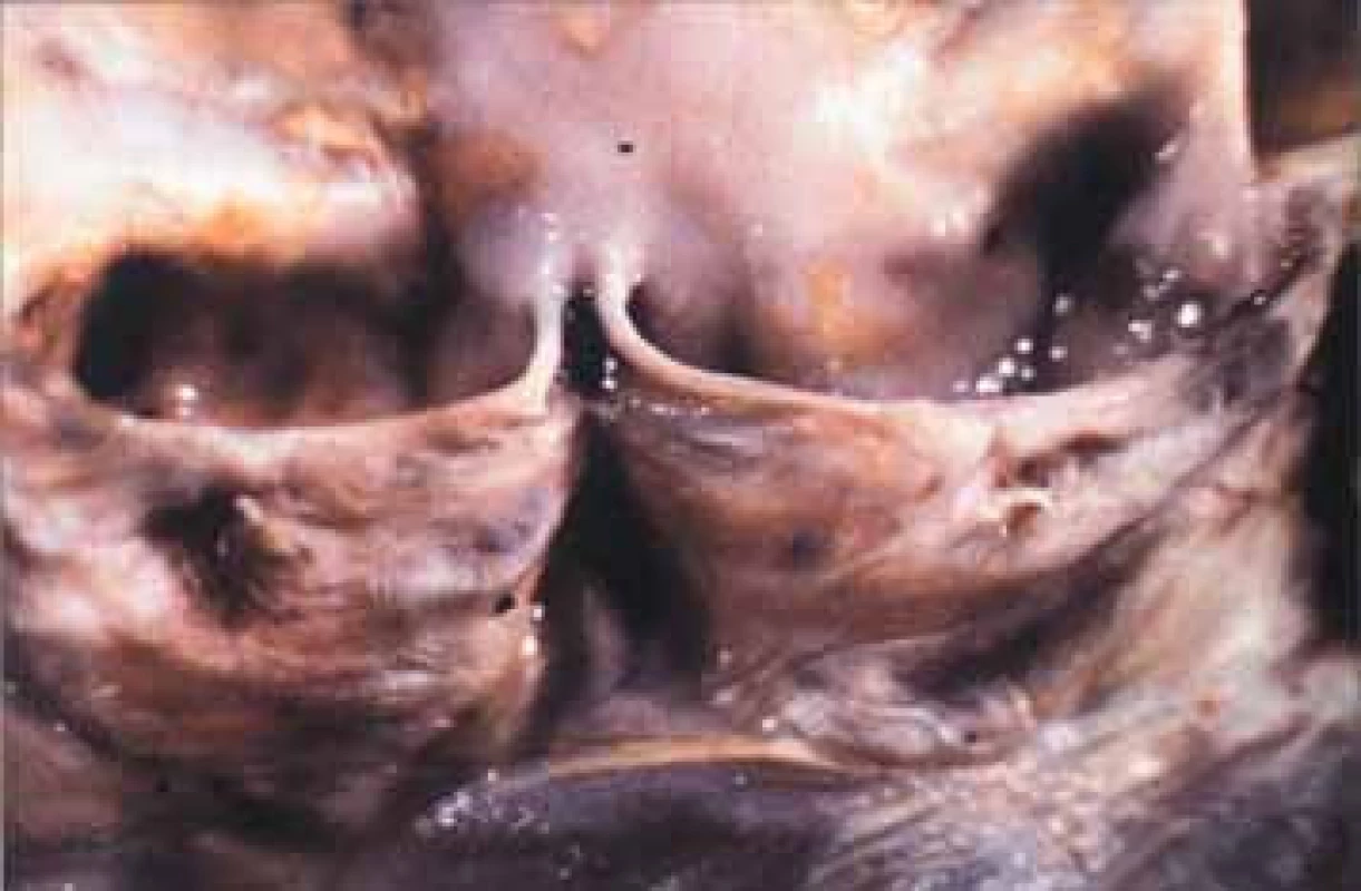 Lehká syfilitická choroba aortální chlopně. Komisura je rozšířená,cípy se nesetkávají, vzestupná aorta má perlově žluté ploché pláty.