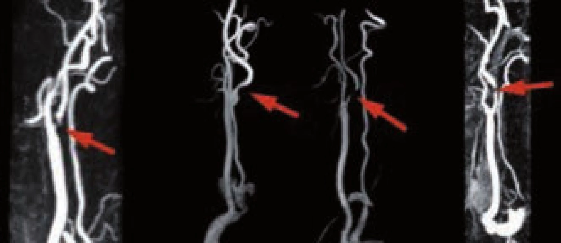 Kontrastní MR angiografie zobrazující stenotické postižení ACI.