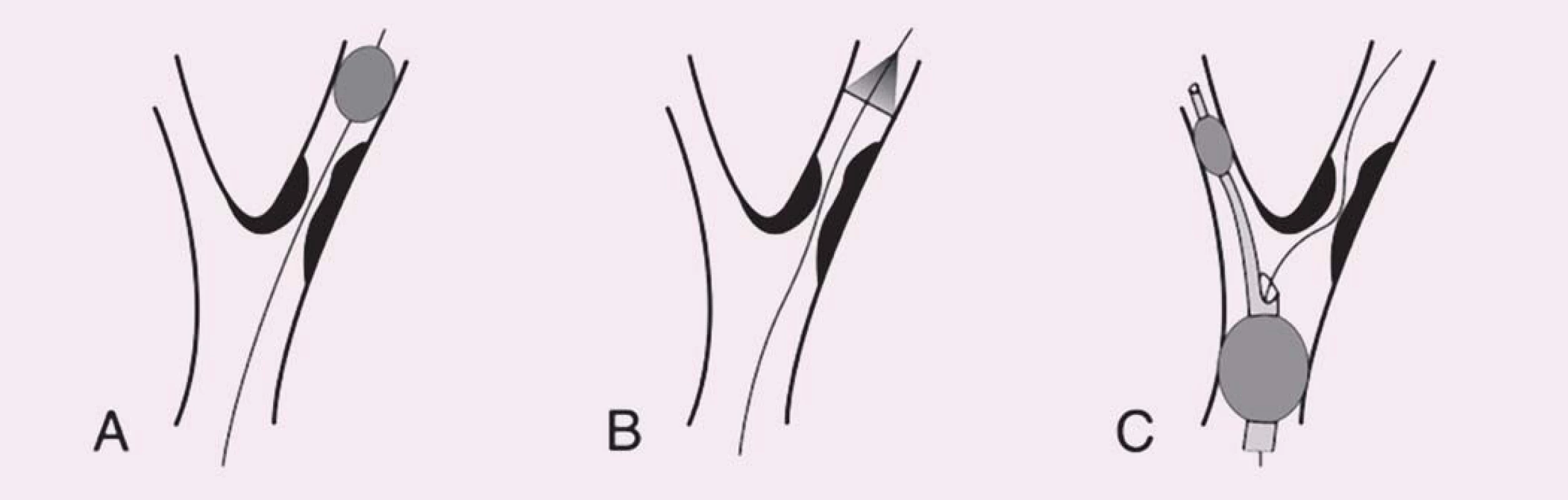 Schematické znázornění typů protektivních systémů. Vodicí drát prochází stenózou vnitřní karotické arterie ve všech panelech. 
A) Distální okluze. B) Distální fi ltr. C) Proximální okluze (distální balon v arteria carotis externa a proximální balon v arteria carotis communis).