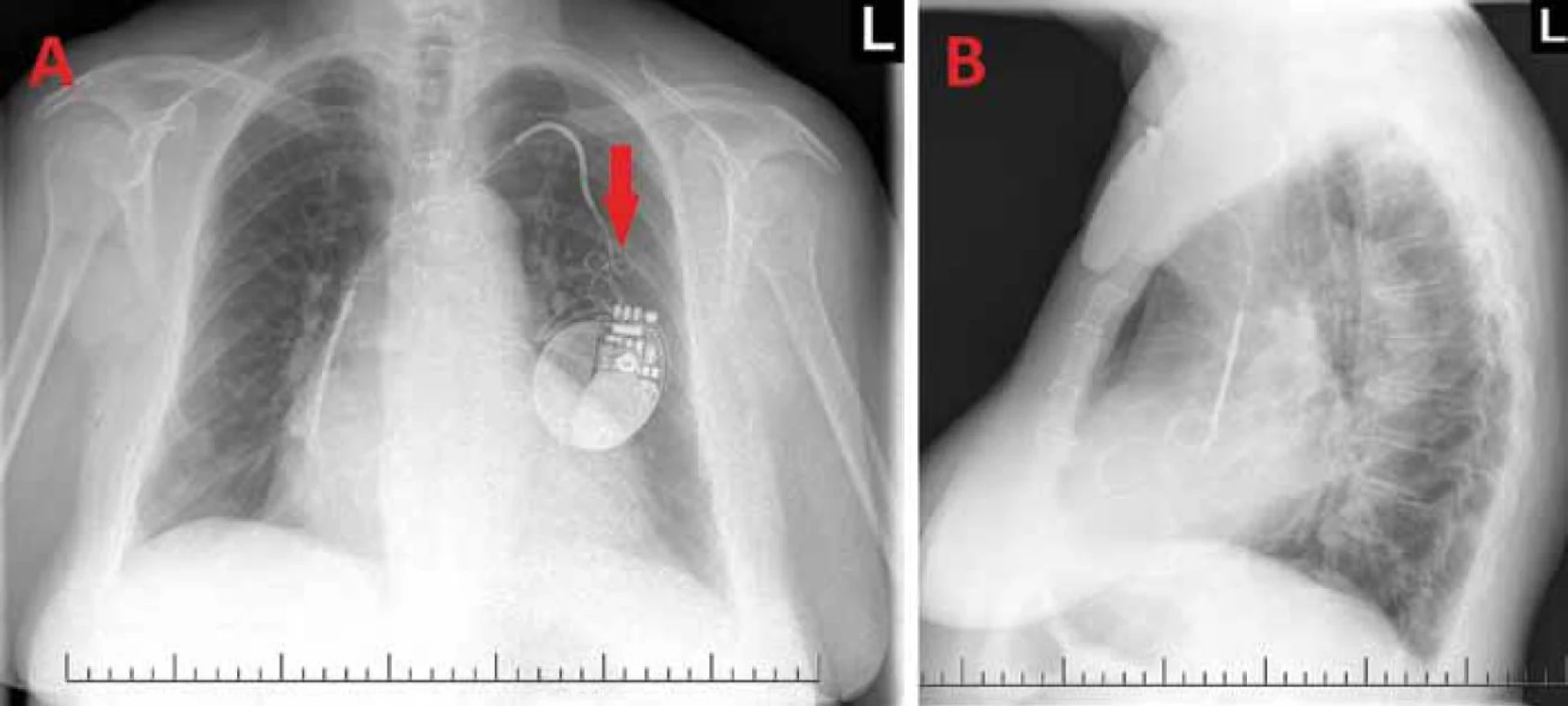 Rentgenový snímek hrudníku – předozadní (A) a levý boční (B): patrná dislokace defibrilační elektrody, jejíž hrot se promítá do oblasti pravé srdeční síně. Šipka ukazuje na konvoluty vytvořené z povytažené elektrody v oblasti kapsy generátoru ICD.