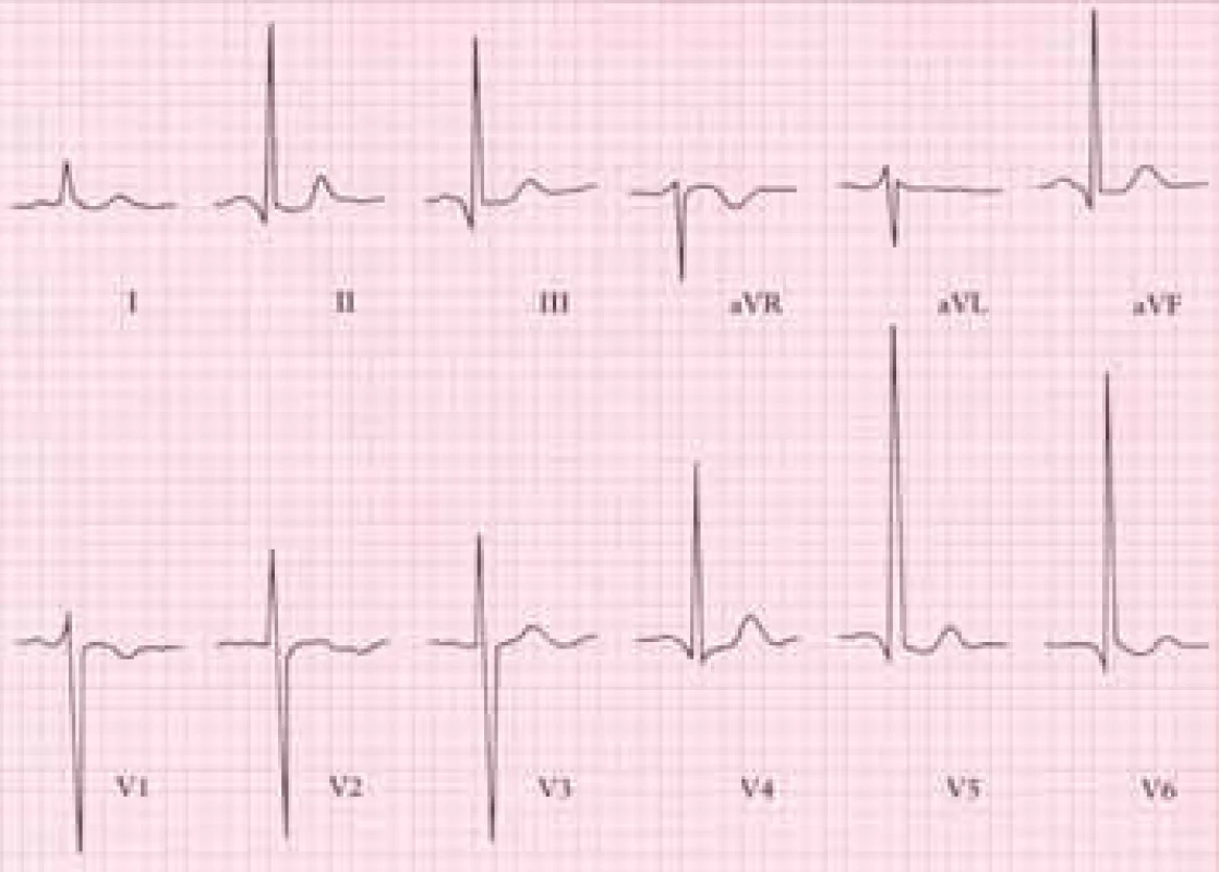 EKG u chronické aortální regurgitace ukazuje zvýšenou voltáž nad levou komorou (hluboké S ve V1 a vysoké R ve V6)
