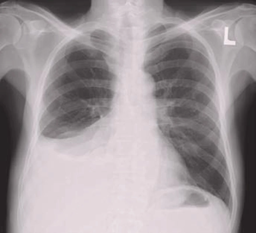 Pravostranný pleurální výpotek na zadopředním rentgenovém snímku hrudníku.