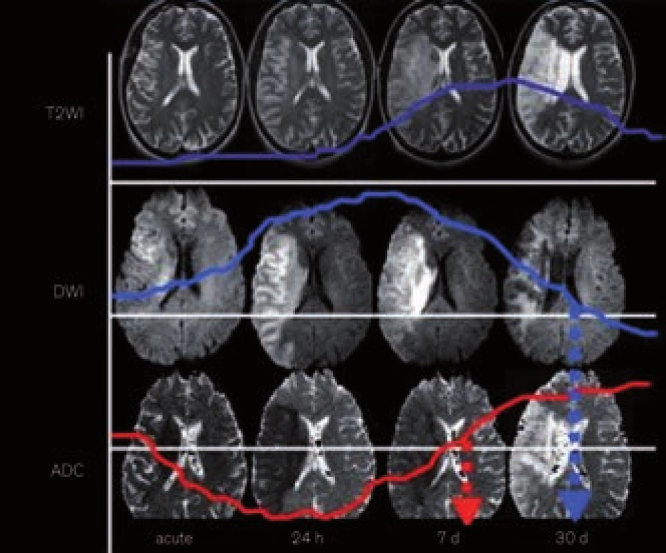 Vývoj změn u akutního mozkového infarktu na T2, DWI a ADC mapách.