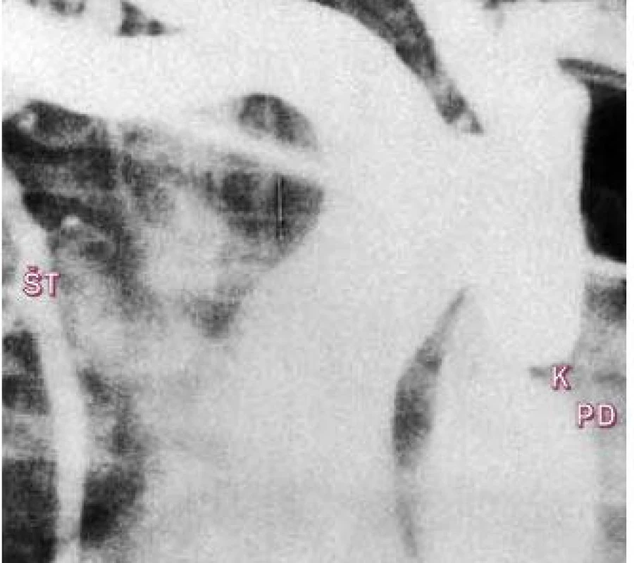 Aortogram v antero-posteriorní projekci ukazuje zúžení při junkci istmu se sestupnou aortou. Dilatovaná vnitřní mamární tepna.