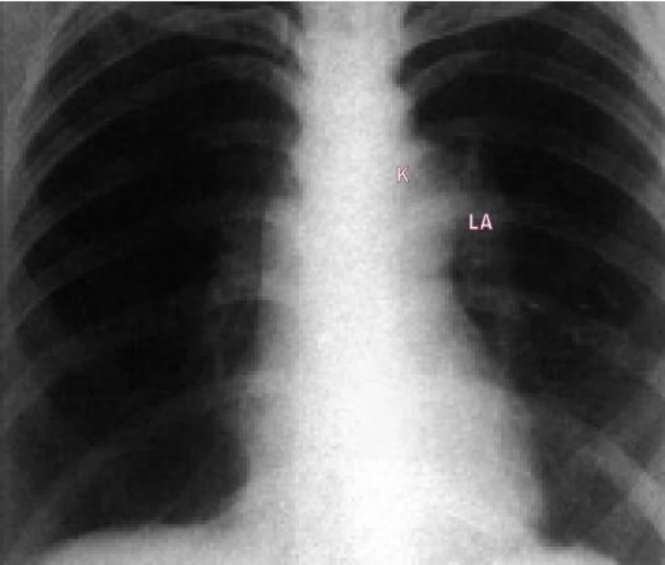 Skiagram u lehké stenózy ukazuje poststentickou dilataci plicnice a prominující levou plicní arterii.