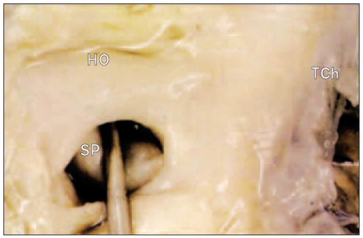 Foramen ovale. Sonda proniká mezi klopou chlopně a okrajem fossa ovalis. Po vytažení sondy cíp defekt uzavře.
