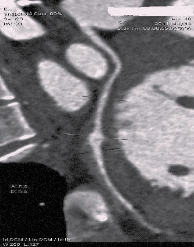 Obraz CT nálezu aneuryzmatu na ramus cirkumflexus (RCx).