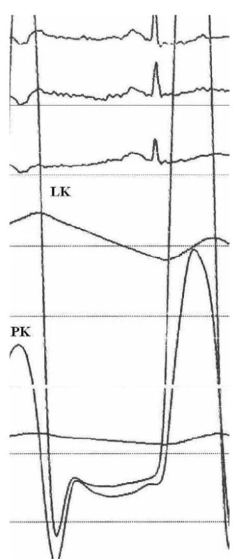Tlakové křivky z levé a pravé komory. V diastole dochází k rychlému vzestupu krevní tlaku s křivkou ve tvaru „dip a plateau“. Navíc jsou diastolické tlaky v obou srdečních komorách téměř vyrovnány, což svědčí pro diagnózu konstriktivní perikarditidy u tohoto pacienta.
