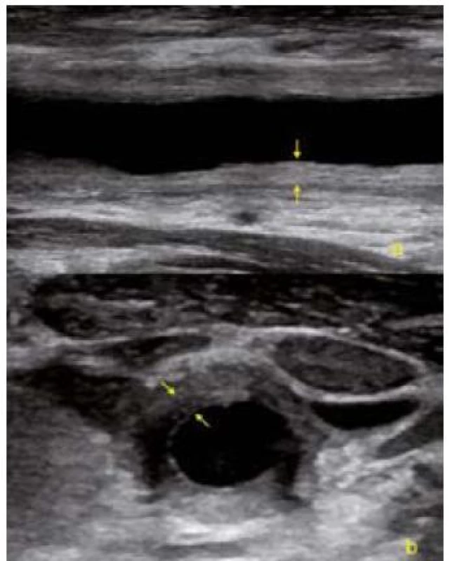 USG obrázek difuzního zesílení cévní stěny společné karotidy v akutní fázi Takayasu arteritidy. a – podélná projekce, b – příčná projekce.
