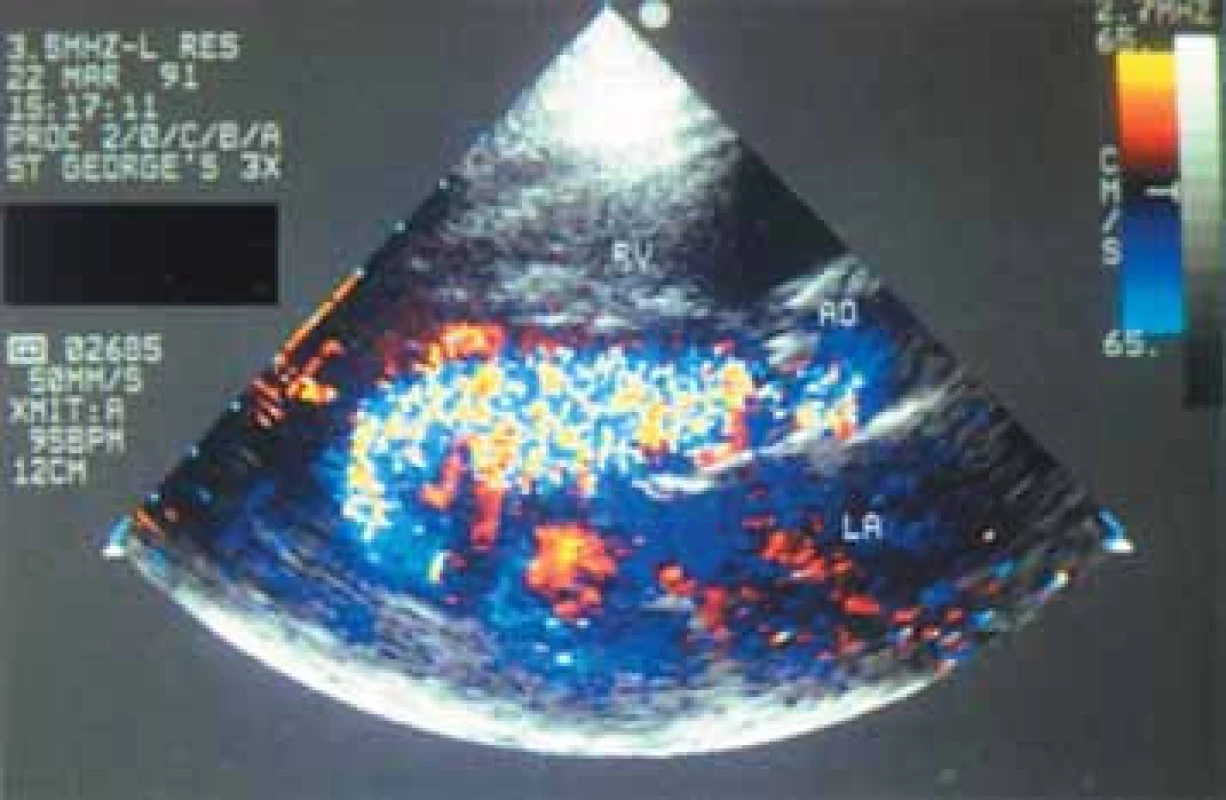 Barevná dopplerovská echokardiografie v určení tíže aortální regurgitace: (a) U relativně mírné regurgitace je jet úzký a jeho penetrace do levé komory omezená. (b) U velmi těžké aortální regurgitace jet vyplňuje výtokový trakt levé komory a penetruje přímo k apexu. I když může barevná dopplerovská echokardiografie rozlišit takové krajní situace, je při nejlepším pouze semikvantitativním prostředkem, velmi závislým na úhlech toku, nastavení
gainu a technice vyšetření.