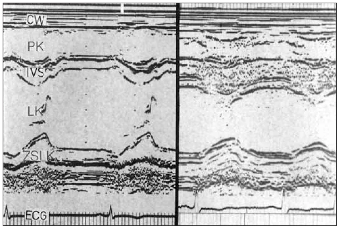 M-mode vlevo ukazuje normální levou komoru a vpravo případ aortální stenózy s těžkou koncentrickou hypertrofií a značně redukovanou rychlostí časného plnění. Dynamika plnění je podobná jako u mitrální stenózy.