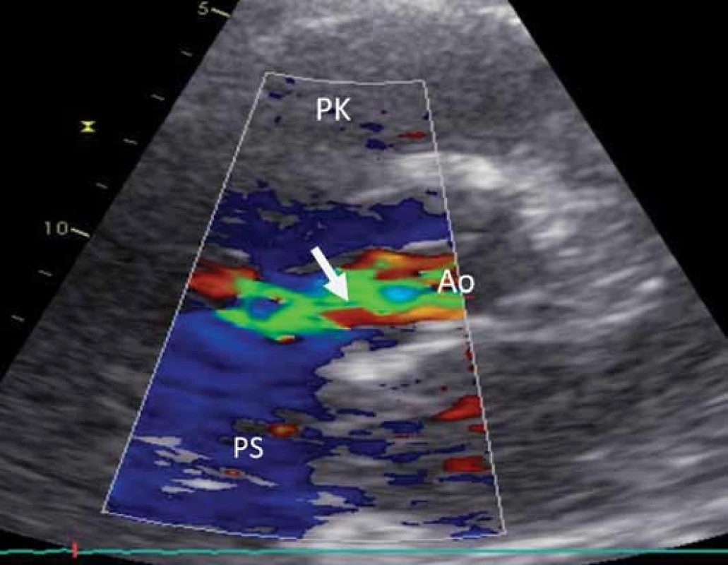 Transthorakální echokardiografie (SAX –parasternální krátka osa). Barevným dopplerem zobrazen zkratový jet mezi aortou a pravou síní.