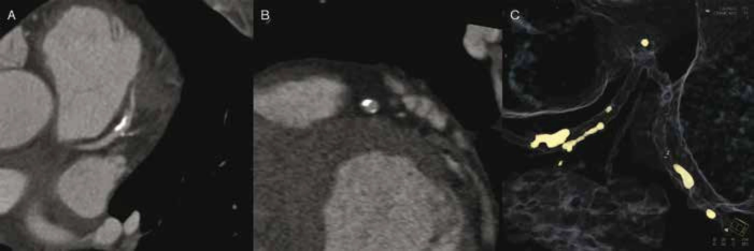 CT angiografie: typický zcela kalcifikovaný aterosklerotický plát proximální třetiny RIA, který nezpůsobuje hemodynamicky významnou stenózu (A–B). Cílená rekonstrukce na kalcifikace (C).