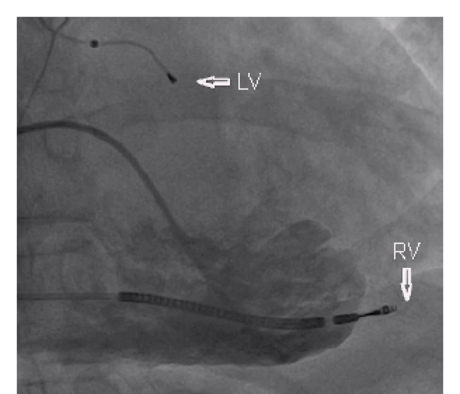 Pravostranná ventrikulografie – patrný jasný přesah defibrilační elektrody mimo konturu pravé  komory (LV – levokomorová elektroda, RV – defibrilační elektroda).