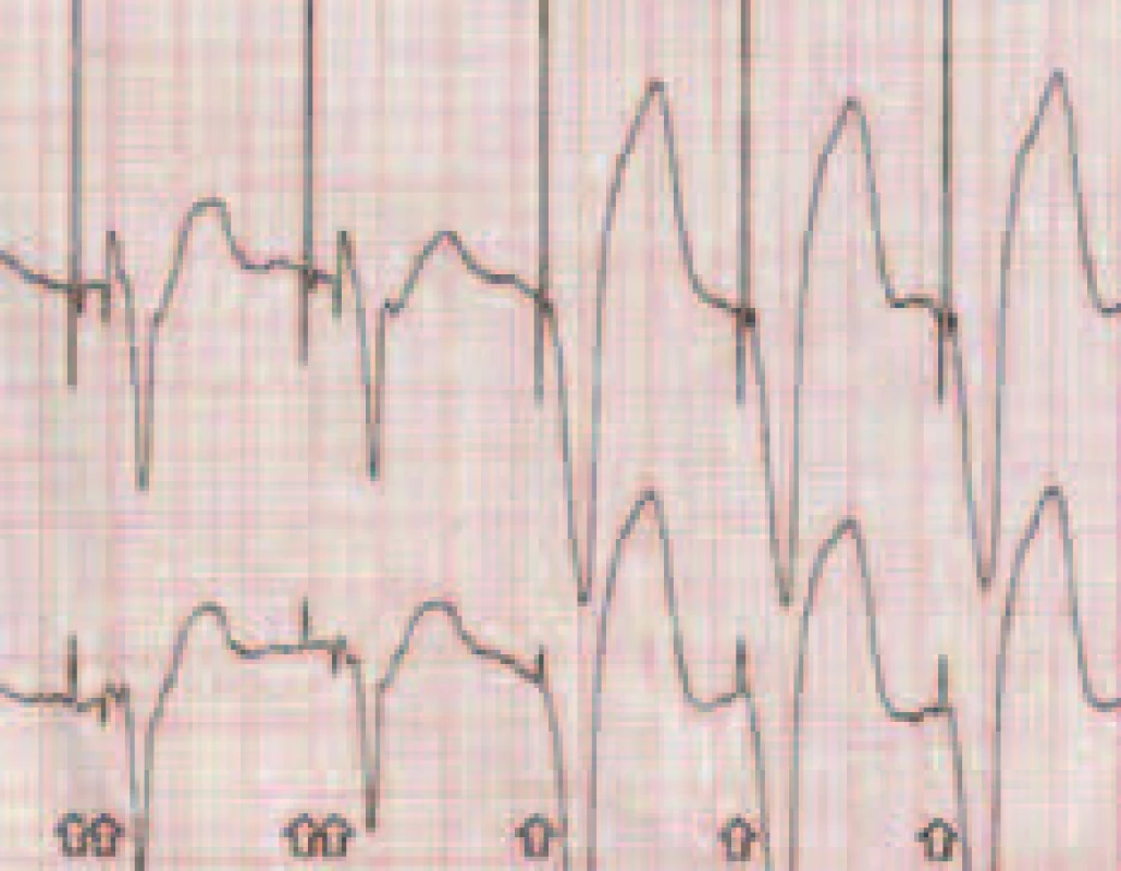 Funkce AutoCapture™ firmy St. Jude Medical. Záznam povrchového EKG. U prvních dvou stahů je efektivní až záložní (back-up) pulz. U dalších 3 je komorová stimulace efektivní. (První dva stahy jsou splynulé – fusion beats).