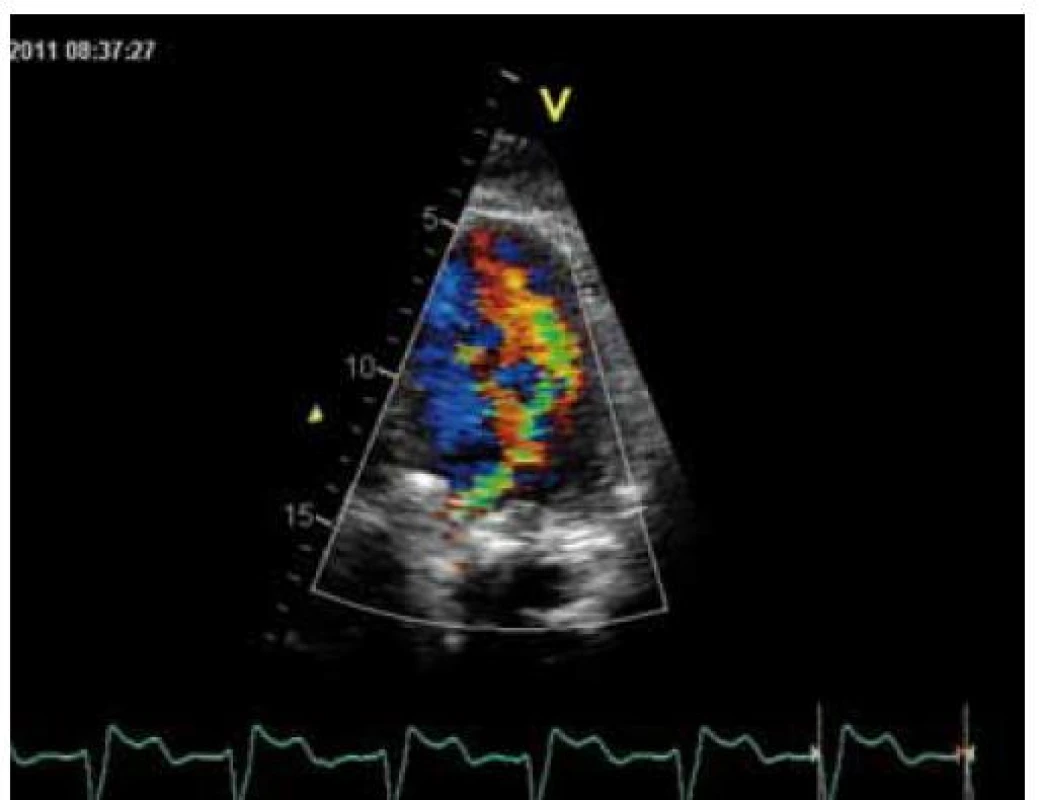 Transtorakální echokardiografie. Významná aortální regurgitace z apikální čtyřdutinové projekce s aortou – CFM zobrazení.