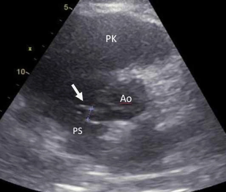 Transthorakální echokardiografie (SAX – modifikovaná projekce, parasternální krátka osa). Šipka zobrazuje kanálek velikosti 6 mm mezi aortou a pravou síní.