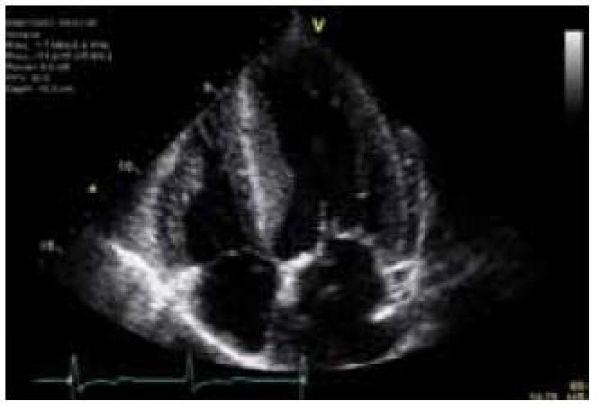 Echokardiografický obraz koncentrické hypertrofie levé komory u nemocného s Fabryho chorobou (apikální čtyřdutinová projekce).