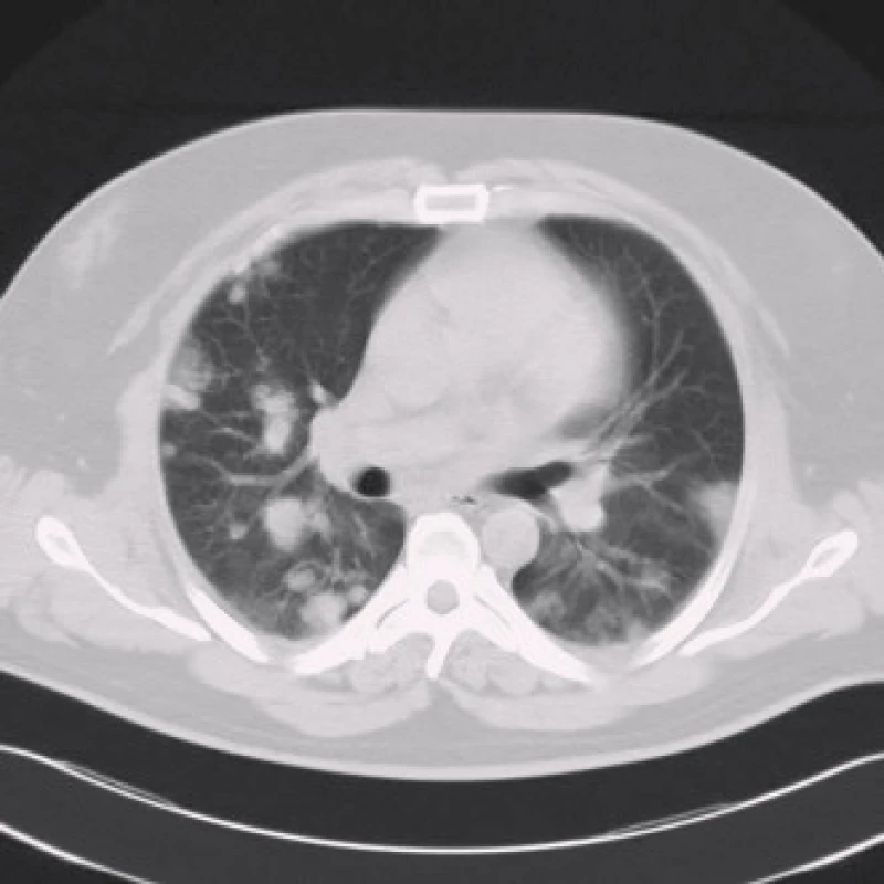 CT hrudníku v roce 2007 – na transverzálním řezu v plicním okně jsou sledovatelná mnohočetná kulovitá ložiska v náhodné distribuci, typická pro plicní metastázy.