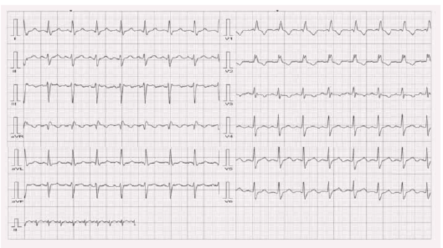 Nativní EKG u stejného pacienta jako na obr. 7.