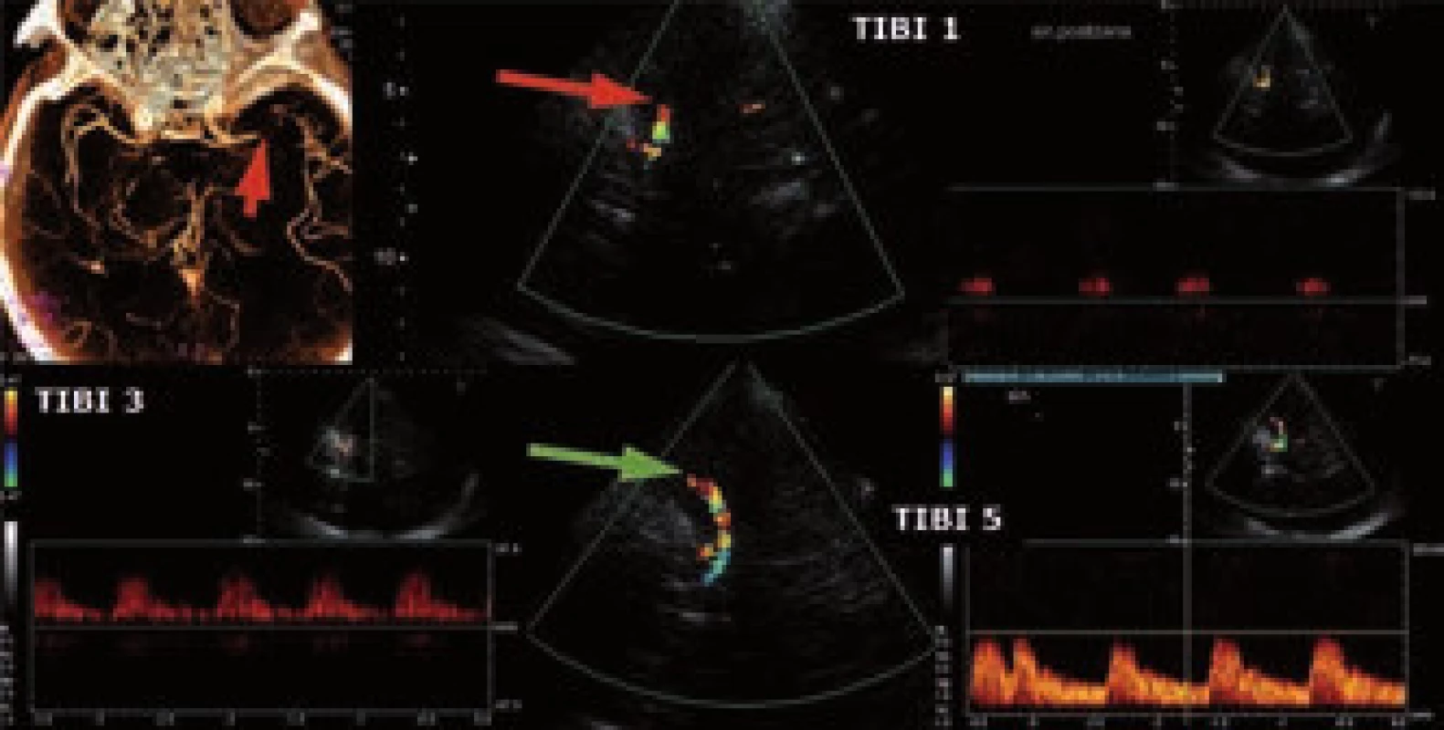 Monitorace IVT pomocí transkraniální ultrazvuku (TCCD). Nahoře okluze a. cerebri media v úseku M1 na CTA a v UZ obraze, dole nález kompletní rekanalizace po IVT.