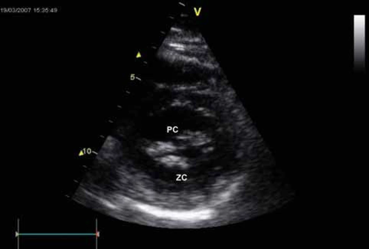 Echokardiografie u mitrální stenózy – B-mode zobrazení, krátká osa parasternálně. Ztluštění cípů, redukce MVA.