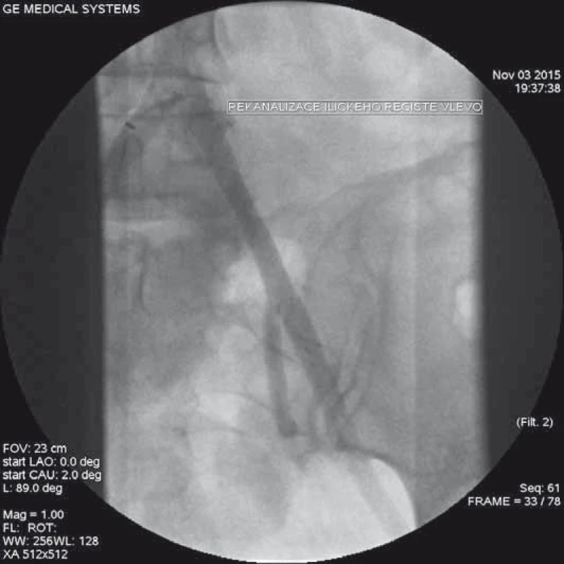 Angiografie po zavedení dvou stentů do levého ilického řečiště s obnovením úplné perfuze vč. oblasti vnitřní ilické arterie.