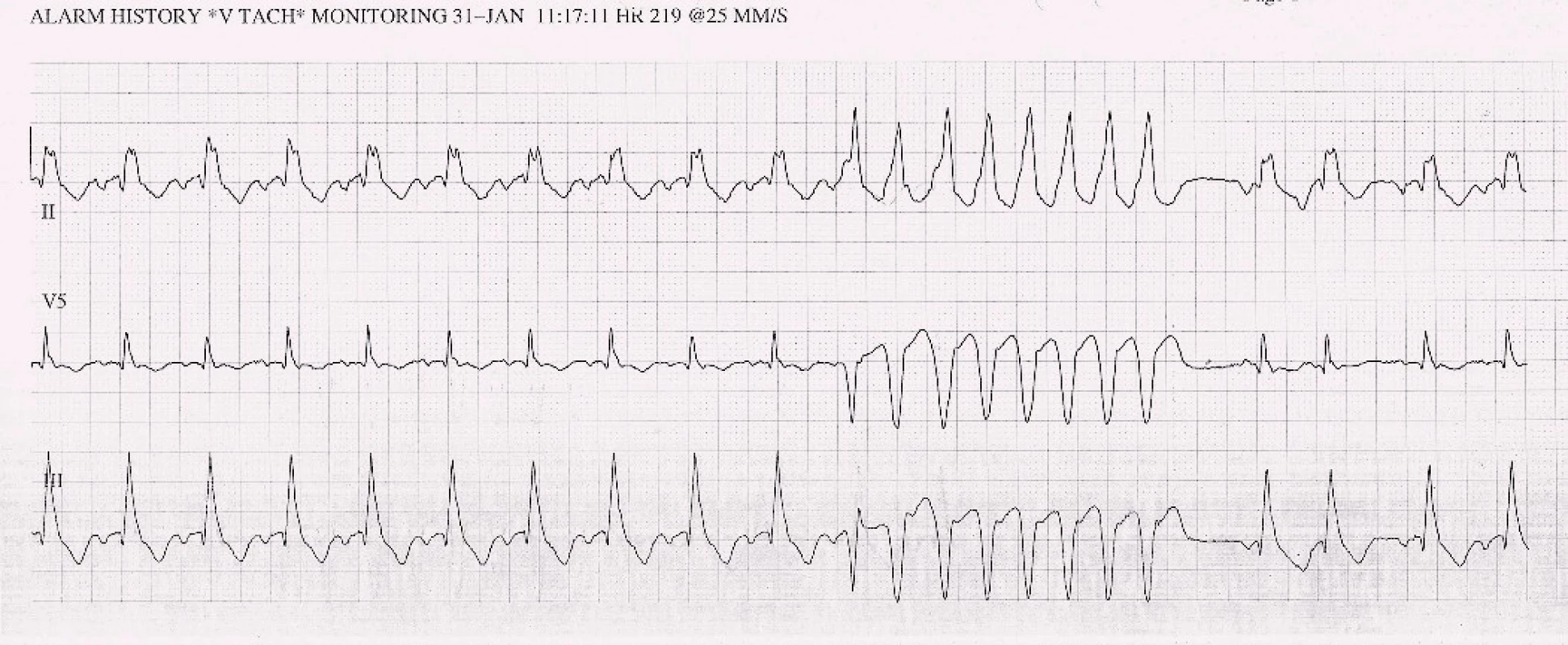 EKG – strip se záznamem nesetrvalé komorové tachykardie v roce 2013.