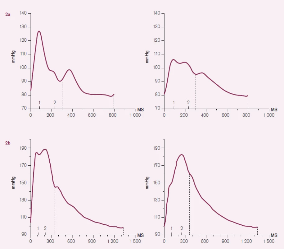 Typický tvar tlakové vlny u mladého ( obr. 2a) a staršího jedince ( obr. 2b). Grafy nalevo znázorňují tvar vlny v řečišti radiální tepny, napravo v centrálním řečišti (v aortě). U mladého jedince je druhotná vlna nízká (její vrchol je označen na ose X číslem 2) a nezvyšuje pulzní tlak ani v periferním ani v centrálním řečišti. Jedná se o křivky 22letého muže, brachiální TK je 127/ 79 mmHg, odhadnutý centrální TK 107/ 80 mmHg, vrchol odražené vlny v centrálním řečišti je o 2 mmHg pod úrovní primární tlakové vlny. U staršího jedince může odražená vlna mírně navyšovat pulzní tlak v periferním řečišti, ale k mohutnému navýšení dochází především v centrálním řečišti. Na obrázku 2b jso u křivky 78leté ženy, brachiální TK je 188/ 98 mmHg, centrální TK 182/ 99 mmHg, odražená vlna navyšuje centrální pulzní TK o 32 mmHg. Vlastní pozorování.