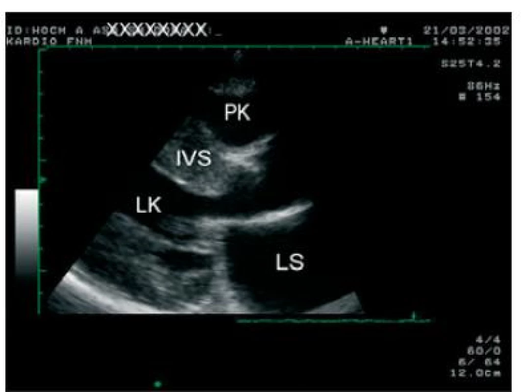 Transtorakální echokardiografie, dlouhá osa parasternálně. Je přítomna asymetrická hypertrofie IVS.