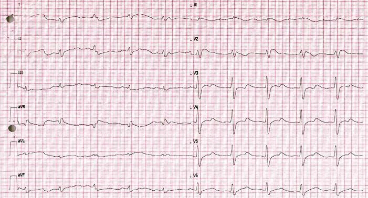 EKG po resuscitaci se známkami charakteristickými pro Brugada syndrom.