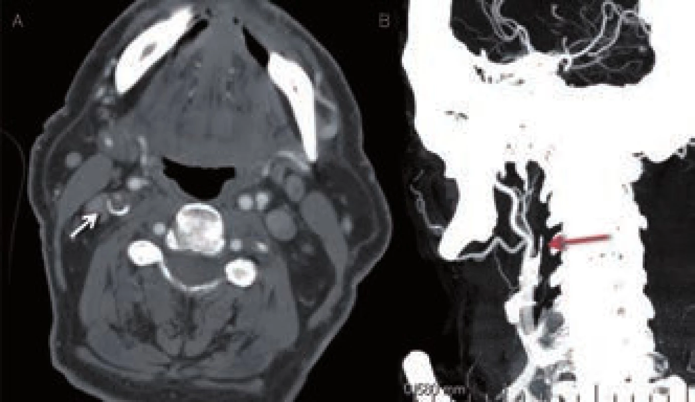 CT angiografické zobrazení okluze v odstupu ACI vpravo. A – zdrojový snímek, B – rekonstrukce.